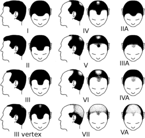 Illustration af Hamilton-Norwood skalaen som man bør bruge, hvis man vil beslutte sig for, om man vil have en hårtransplantation